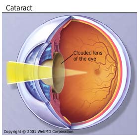 oog met cataract