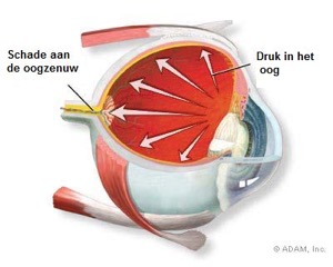 glaucoom oogdruk